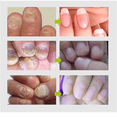 Gel De Reparación De Uñas Fúngica Infección Antifúngica Crema Para El