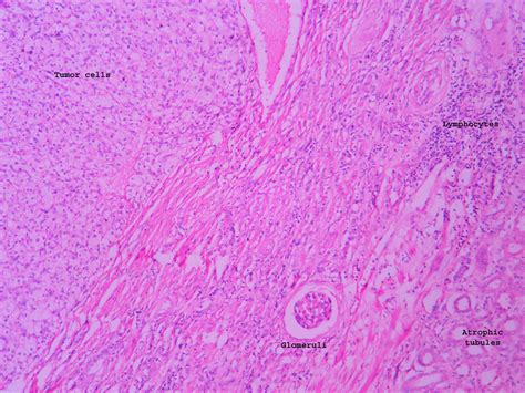 Renal cell carcinoma – UG slide – Histopathology.guru