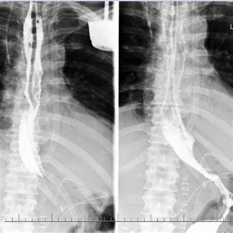 Upper Endoscopy Hiatal Hernia