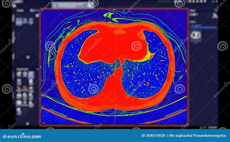 Ct Scan Of Chest Axial View In Color Mode For Diagnostic Pulmonary