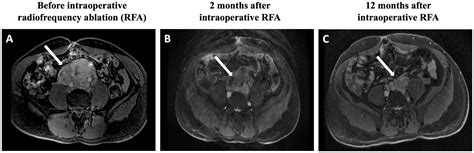 Frontiers Intraoperative Radiofrequency Ablation For Unresectable