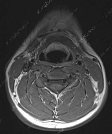 Normal neck and cervical spine, MRI - Stock Image - C039/3618 - Science Photo Library