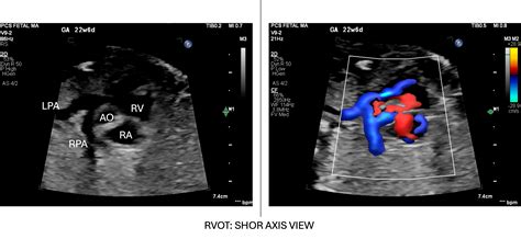 Fetal Branch Pulmonary Artery Doppler: Technique, Interpretation, and