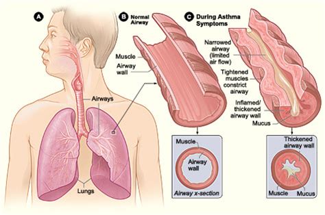 Asthma vs COPD - Difference and Comparison | Diffen