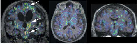 Corticobasal Degeneration The Lancet Neurology