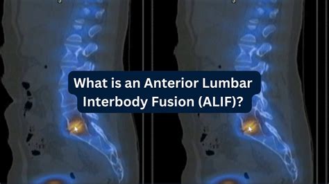 What Is An Anterior Lumbar Interbody Fusion Alif Youtube