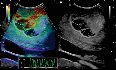 Figure 1 From Comparison Of Intraoperative Ultrasound B Mode And Strain