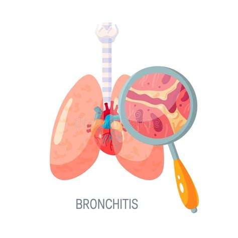 Bronchitis Vector Illustration Lung Disease Diagnosis With Symptoms