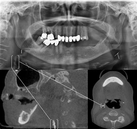 64-year-old female patient with a BMI of 28. At the time of recording ...