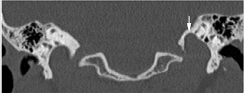 Temporal Ct Coronal Reformatted Image Shows The Left High Riding