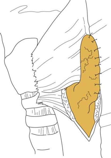 Figure 4 from Zenker’s diverticulum | Semantic Scholar