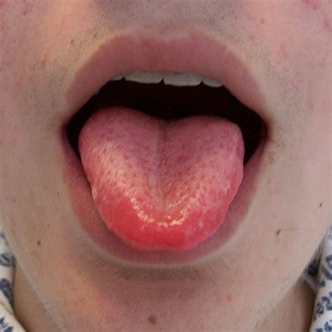 Red Sore On Tongue