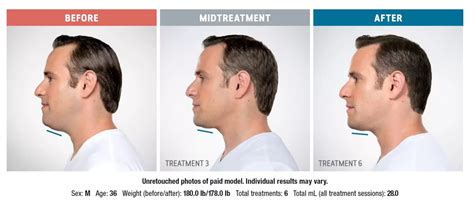 Say Goodbye To Double Chin With Kybella Blue Med Center