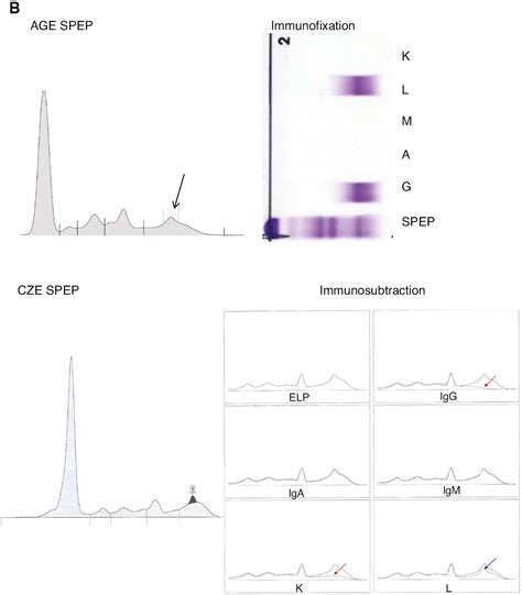 Serum Protein Electrophoresis And Immunofixation 56 OFF