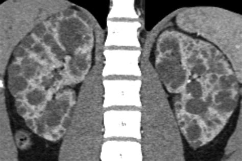 Role Of Mdct Angiography In Selection And Presurgical Planning Of