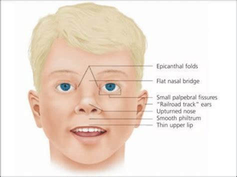 Facial Features of a Child with a Full FAS Diagnosis -... | Download Scientific Diagram