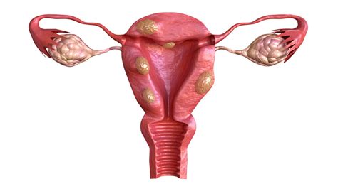 What is the size of fibroids? - Vascular Health