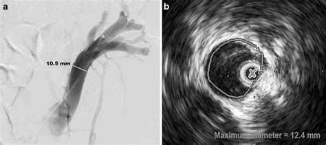 Measurement Techniques A B Digital Subtraction Angiography DSA A