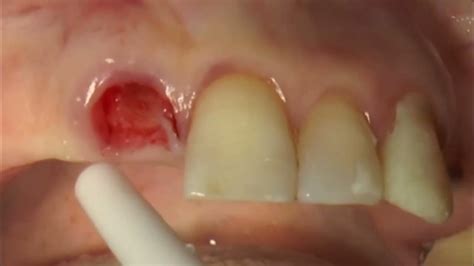 Immediate Implant Placement Using The Neodent Implant System Youtube