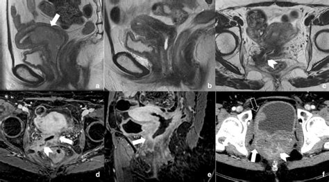 A 52 Year Old Woman With A Figo Iia Cervical Cancer Arrow In A Download Scientific Diagram