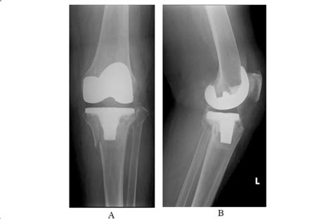 A Preoperative Antero Posterior X Ray B Preoperative Lateral Angle X Ray Download Scientific