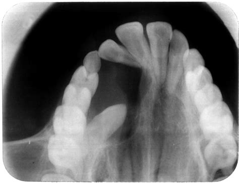 Occlusal Radiograph Showing Radiolucency Extending To The First Download Scientific Diagram