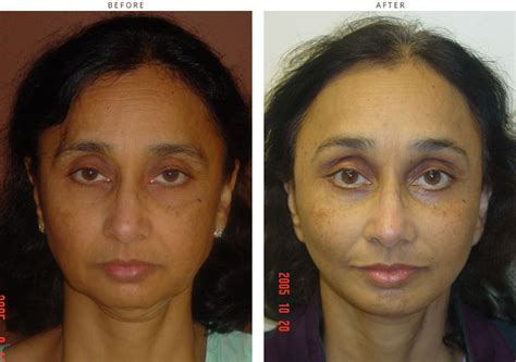 Mini Face Lift – Before and After Pictures * | Dr Turowski - Plastic ...