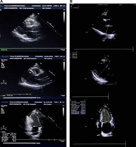 (A) Cardiac ultrasound within 2 mo outside the hospital. (a) Cardiac ...