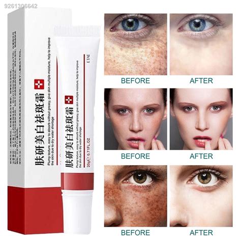 Whitening Freckle Cream Remove Melasma Cream Remove Dark Spots Melanin Melasma Remover Brighten