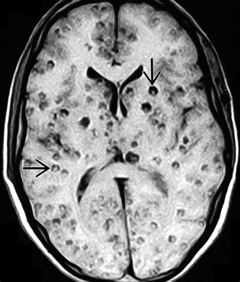 Neurocysticercosis T1w Image Showing The Typical Starry Sky Appearance Of