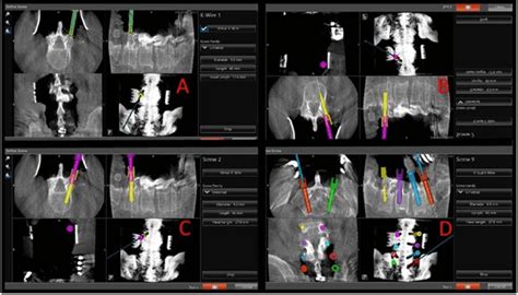 Intraoperative Views Of Navigation Screen Showing Steps Of Virtual