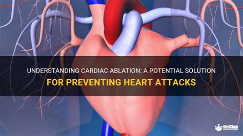 Understanding Cardiac Ablation: A Potential Solution For Preventing Heart Attacks | MedShun