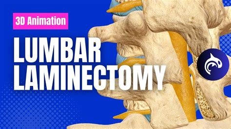 Lumbar Laminectomy 3d Animation Youtube