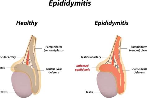 Dealing With An Epididymal Cyst Health And Detox And Vitamins