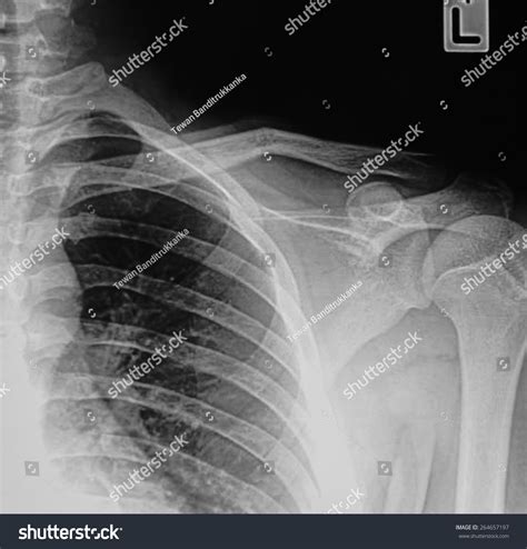 Film Xray Show Fracture Clavicle Stock Photo 264657197 Shutterstock