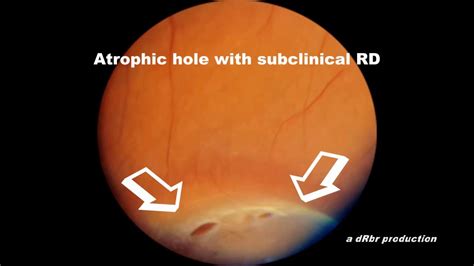 Scleral Depression with DIYretCAM: Atrophic hole with Subclinical ...