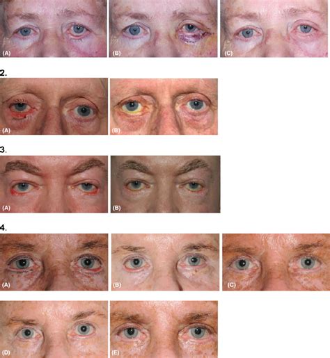 Surgical Outcomes 1 Seventy Five Year Old Patient With Cicatricial