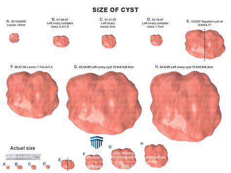 Size Of Ovarian Cyst Trialquest Inc