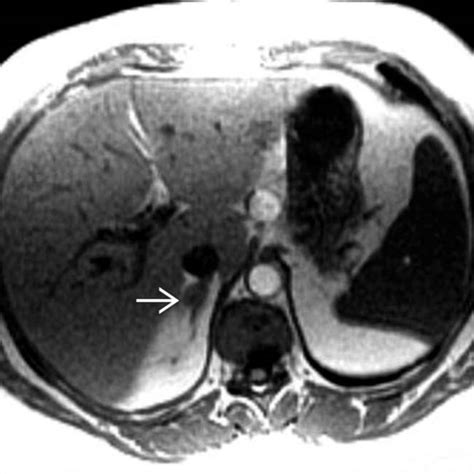 Steatosis And Steatohepatitis Radiology Key