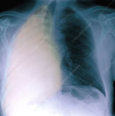 Lung Cancer X Ray Stock Image M Science Photo Library