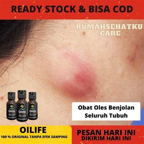 OILIFE OBAT BENJOLAN ORIGINAL MINYAK OLES BENJOLAN PENGHILANG