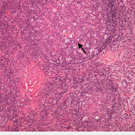 X100 Magnification Using Hematoxylin And Eosin Stain Hande Which Shows