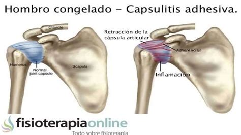 Capsulitis Adhesiva O S Ndrome De Hombro Congelado Pptx