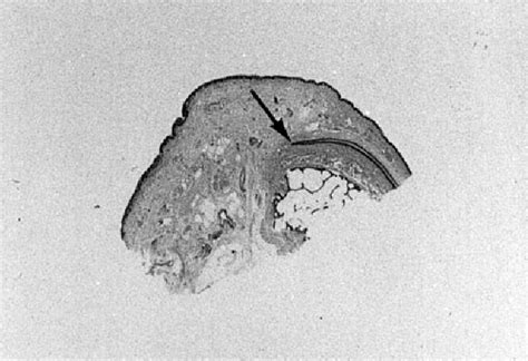 Figure 4 From The Surface Anatomy Of The Germinal Matrix Of The Nail