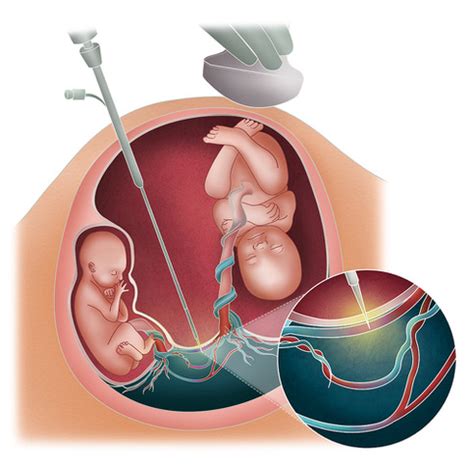 Sindrome De Transfusion Feto Fetal Todaygetty