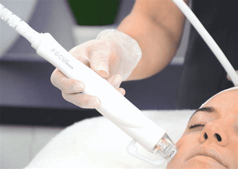 Radiofrequency Microneedling Chester Clinic 10