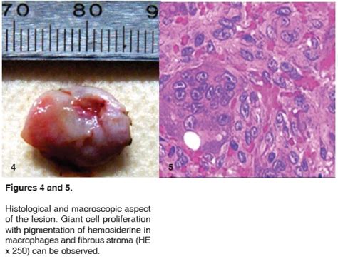 Peripheral Giant Cell Granuloma Histology