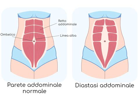 Diastasi Addominale Sintomi Intervento Esercizi E Altri Rimedi