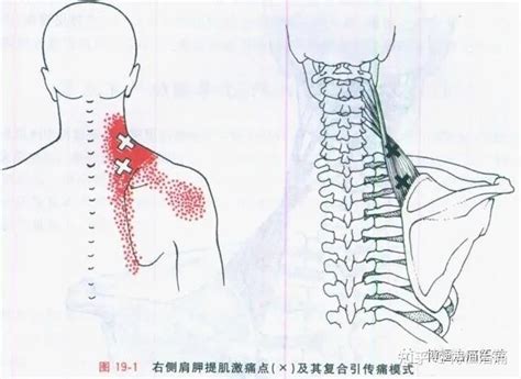 再看肩胛提肌损伤 知乎