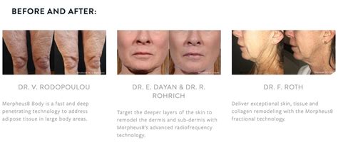 Morpheus8 Skin Tightening Resurfacing Acne Scarring — Best